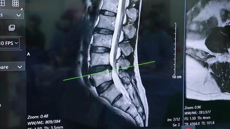 B﻿ệnh nhân tự đi lại sau 3 giờ mổ thoát vị đĩa đệm